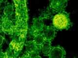 Urethritis in Men